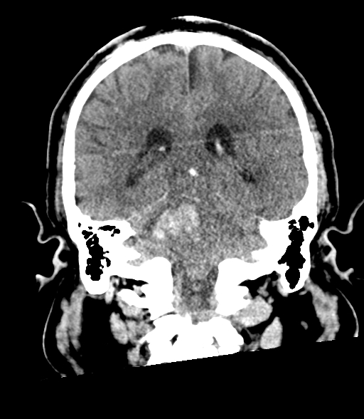 Brainstem hemorrhage (Radiopaedia 81294-94976 Coronal non-contrast 44).jpg