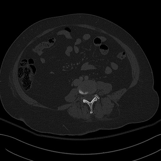 File:Breast carcinoma with pathological hip fracture (Radiopaedia 60314-67993 Axial bone window 1).jpg