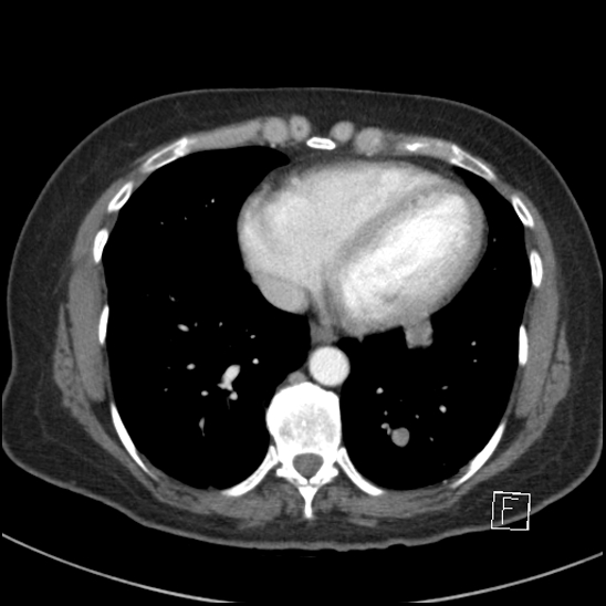 Breast metastases from renal cell cancer (Radiopaedia 79220-92225 A 65).jpg