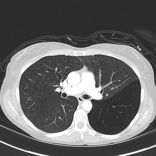 Bronchial atresia (Radiopaedia 73677-84470 Axial lung window 28).jpg