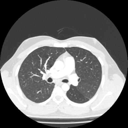 Bronchial carcinoid (Radiopaedia 80013-93291 Axial lung window 47).jpg