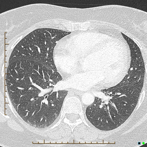 Bronchial diverticula (Radiopaedia 79512-92676 Axial lung window 123).jpg