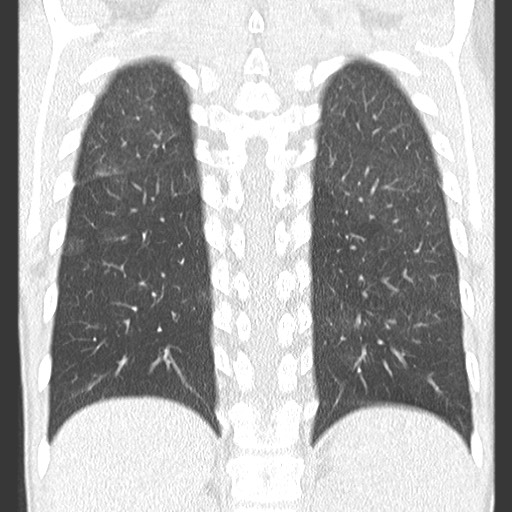 File:Bronchiolotis obliterans (Radiopaedia 73769-84575 Coronal lung window 30).jpg