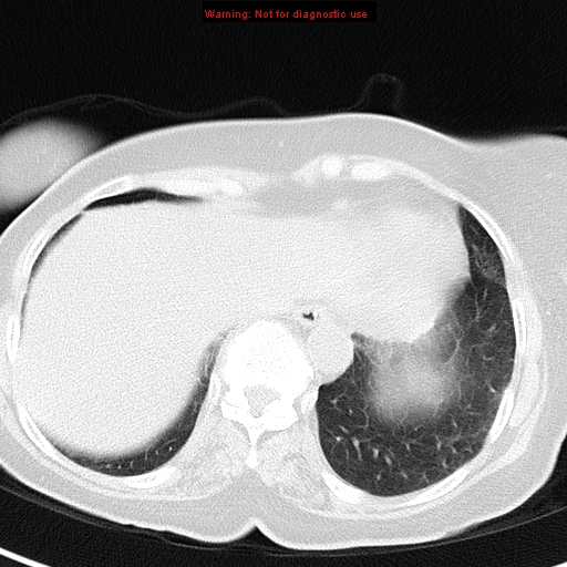 File:Bronchoalveolar carcinoma (BAC) (Radiopaedia 13436-13392 Axial lung window 41).jpg