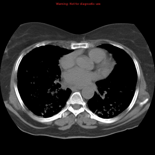 Bronchoalveolar carcinoma (Radiopaedia 13224-13233 Axial non-contrast 26).jpg