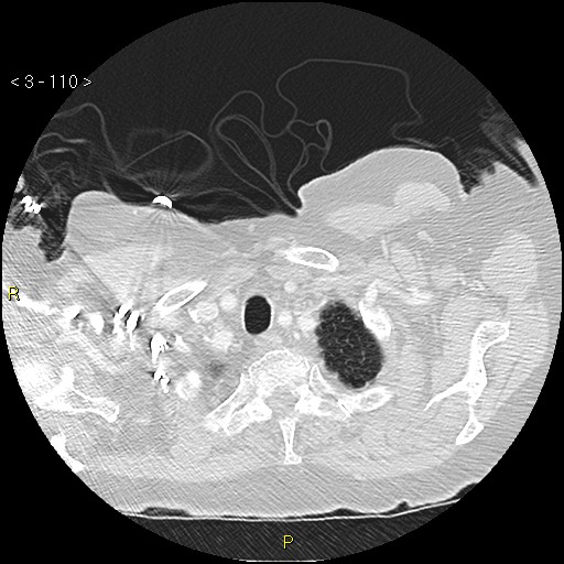 File:Bronchogenic carcinoma as an incidental finding (Radiopaedia 16453-16130 Axial lung window 110).jpg