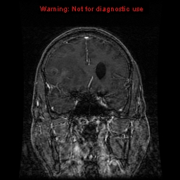 File:Bronchogenic carcinoma brain metastasis (Radiopaedia 9286-9969 Coronal T1 30).jpg
