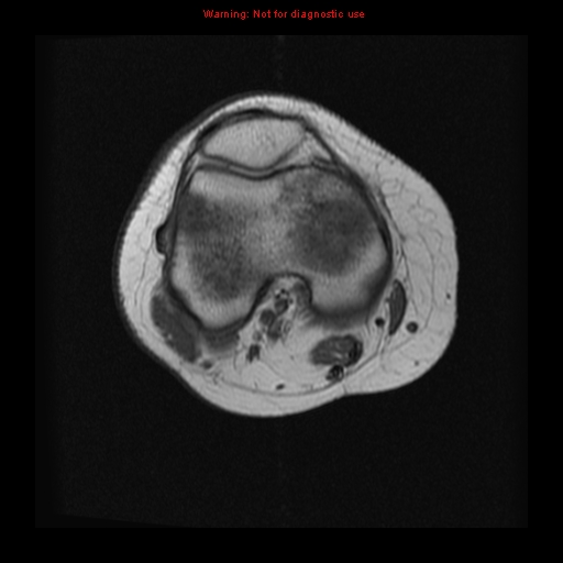 File:Brown tumor (Radiopaedia 12318-12597 Axial T1 5).jpg