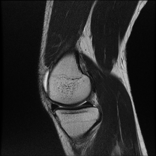 File:Bucket-handle meniscus tear (Radiopaedia 65700-74809 Sagittal T2 8).jpg