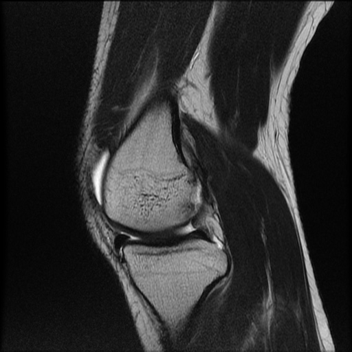 File:Bucket-handle meniscus tear (Radiopaedia 65700-74809 Sagittal T2 9).jpg