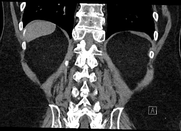 File:Buried bumper syndrome - gastrostomy tube (Radiopaedia 63843-72577 Coronal Inject 112).jpg
