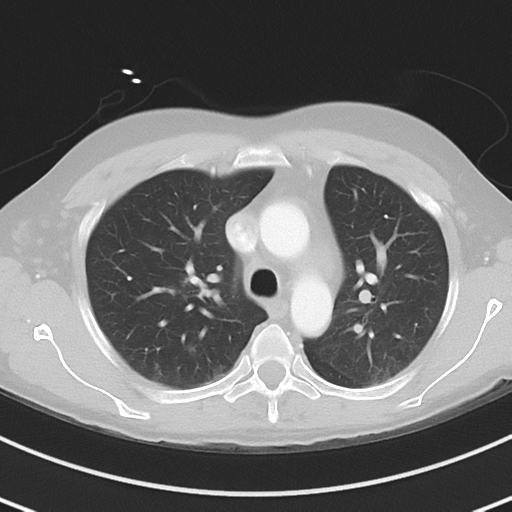 Burkitt lymphoma (Radiopaedia 34686-36121 Axial lung window 17).png