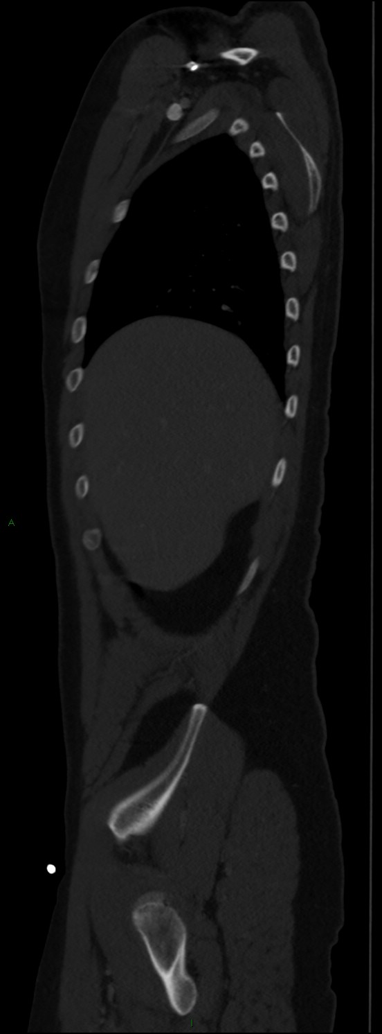 Burst fracture (Radiopaedia 83168-97542 Sagittal bone window 35).jpg