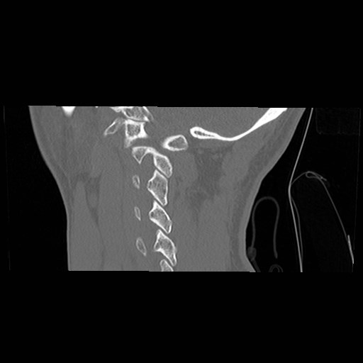 File:C1-C2 "subluxation" - normal cervical anatomy at maximum head rotation (Radiopaedia 42483-45607 C 13).jpg