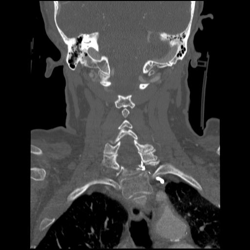 File:C1 anterior arch (plough) fracture - type 1 (Radiopaedia 76181-87720 Coronal bone window 40).jpg