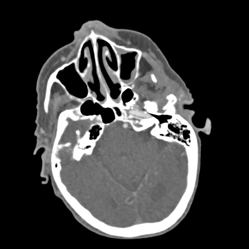 File:C2 fracture with vertebral artery dissection (Radiopaedia 37378-39200 A 215).png