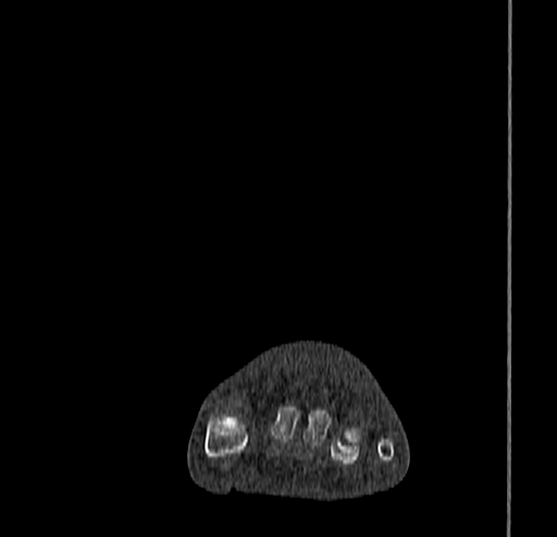 Calcaneal fracture - Sanders type 4 (Radiopaedia 90179-107370 Coronal bone window 21).jpg