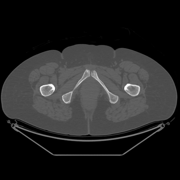 Calcific tendinitis of the gluteus medius muscle (Radiopaedia 66998-76318 Axial bone window 69).jpg