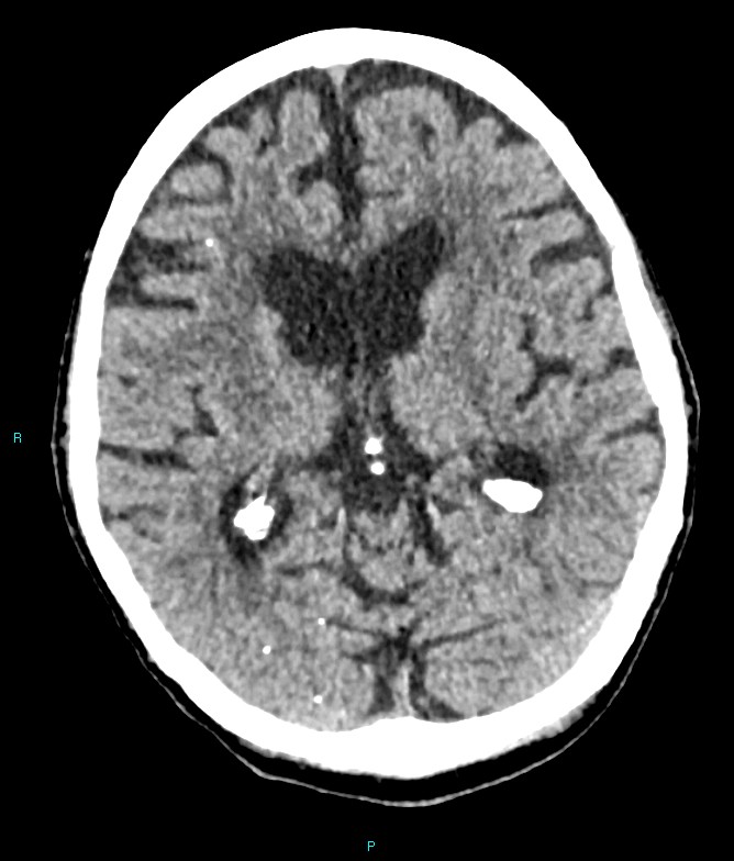 Calcified cerebral emboli from left ventricular thrombus (Radiopaedia 84420-99758 Axial non-contrast 48).jpg