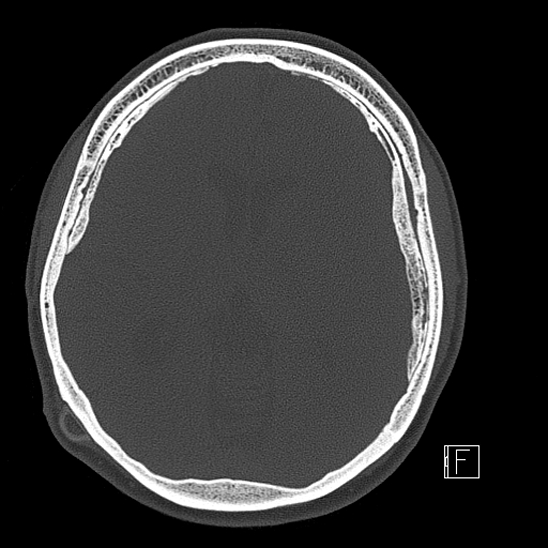 Calcified chronic subdural hematoma (Radiopaedia 77374-89492 Axial bone window 68).jpg