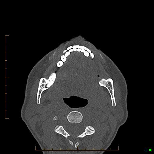 Calcified facial augmentation fillers (Radiopaedia 79514-92679 Axial bone window 117).jpg