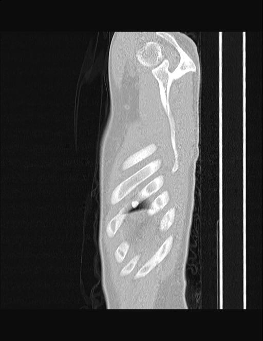 Calcifying pulmonary metastases (Radiopaedia 33359-34396 Sagittal lung window 2).jpg