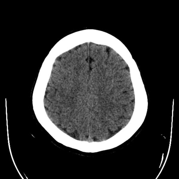 Calvarial osteoma (Radiopaedia 36520-38079 Axial non-contrast 44).jpg