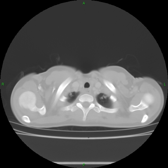 File:Cannon ball metastases - synovial sarcoma (Radiopaedia 26135-26271 Axial lung window 4).jpg