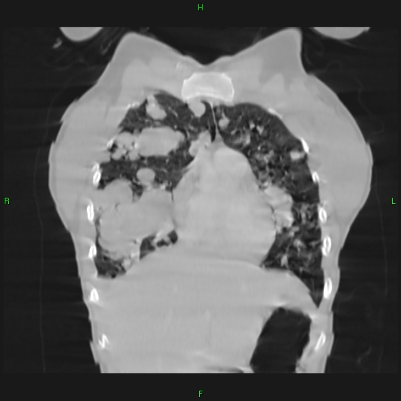 File:Cannon ball metastases - synovial sarcoma (Radiopaedia 26135-26271 Coronal lung window 2).jpg