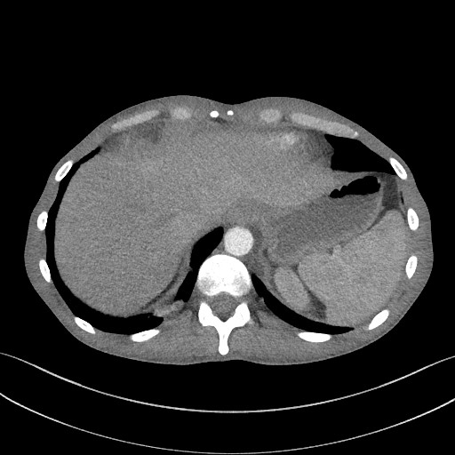 Cannonball metastases - testicular choriocarcinoma (Radiopaedia 84510-99891 B 95).jpg