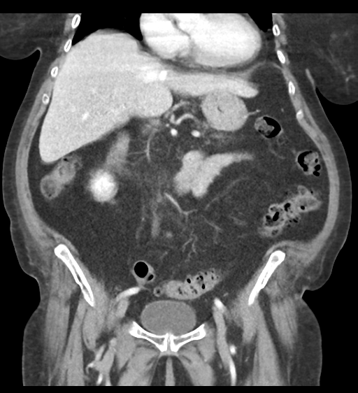 File:Cannonball metastases from endometrial cancer (Radiopaedia 42003-45031 F 33).png