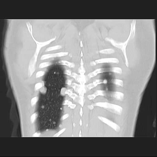 File:Cannonball pulmonary metastases (Radiopaedia 67684-77101 C 23).jpg