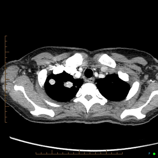 Canonball lung metastasis (Radiopaedia 77634-89837 B 9).jpg