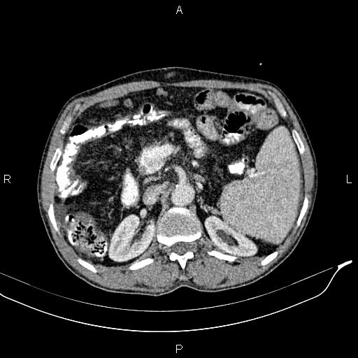 Caput medusae sign - portal hypertension (Radiopaedia 64007-72759 A 31).jpg