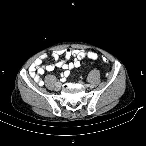 Caput medusae sign - portal hypertension (Radiopaedia 64007-72759 A 73).jpg