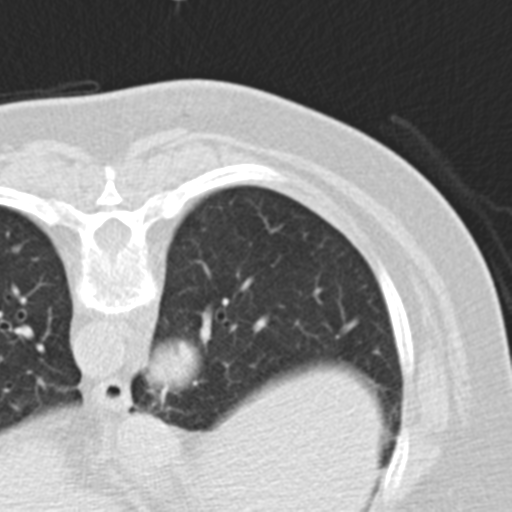 File:Carcinoid tumor - lung (Radiopaedia 44814-48644 Axial lung window 59).png