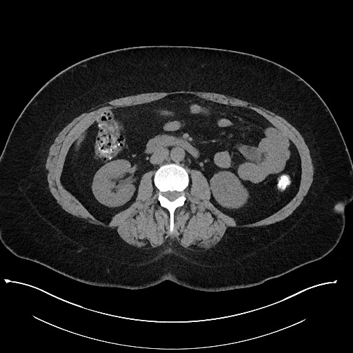 Carcinoid tumor - terminal ileum (Radiopaedia 60931-68740 Axial non-contrast 53).jpg