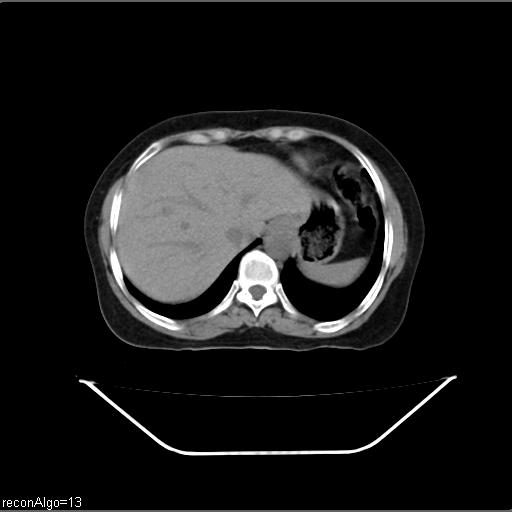 File:Carcinoma cervix- recurrence (Radiopaedia 34702-36137 Axial non-contrast 8).jpg