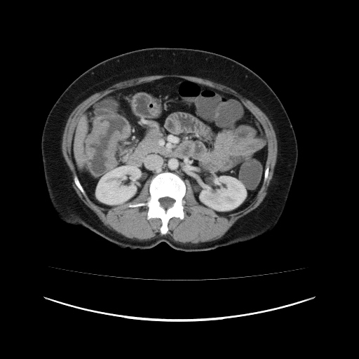 File:Carcinoma colon - hepatic flexure (Radiopaedia 19461-19493 A 53).jpg