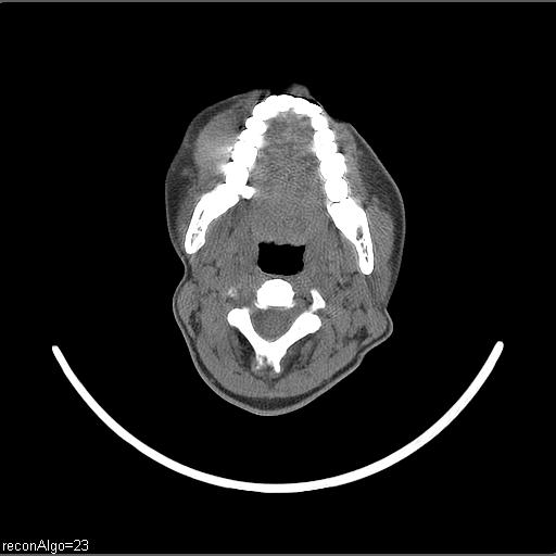 Carcinoma of the maxillary antrum (Radiopaedia 53805-59888 Axial non-contrast 44).jpg