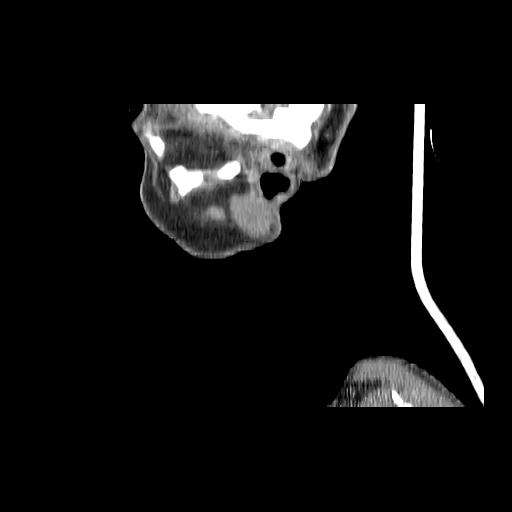 Carcinoma of the maxillary antrum (Radiopaedia 53805-59888 Sagittal C+ delayed 167).jpg