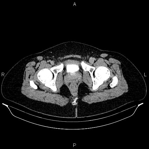 File:Carcinoma of uterine cervix (Radiopaedia 85861-101700 Axial C+ delayed 89).jpg