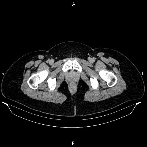 File:Carcinoma of uterine cervix (Radiopaedia 85861-101700 Axial C+ delayed 93).jpg