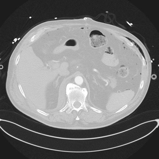 Cardiac trauma (Radiopaedia 32874-33858 Axial lung window 55).jpg