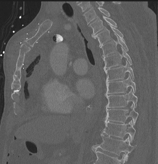 Cardiac trauma (Radiopaedia 32874-33858 Sagittal bone window 49).jpg