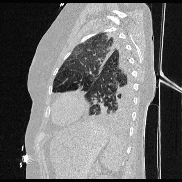 Cardiogenic pulmonary edema (Radiopaedia 29213-29609 Sagittal lung window 76).jpg