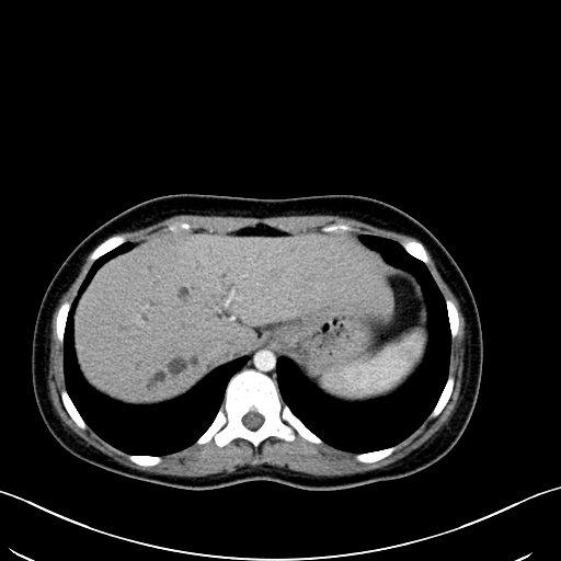 Caroli disease with medullary sponge kidney (Radiopaedia 82622-96804 C 16).jpg