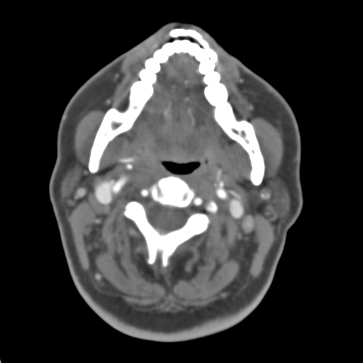 Carotico ophthalmic aneurysm (Radiopaedia 42916-46148 A 59).png