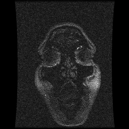 Carotid arterial dissection with acute cerebral infarction (Radiopaedia 26636-26784 MRV 144).jpg