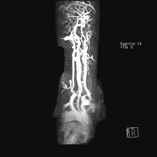 File:Carotid artery dissection (Radiopaedia 28441-28689 MIP Carotids MRA 15).jpg